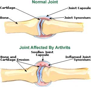 Natural Remedies for Arthritis